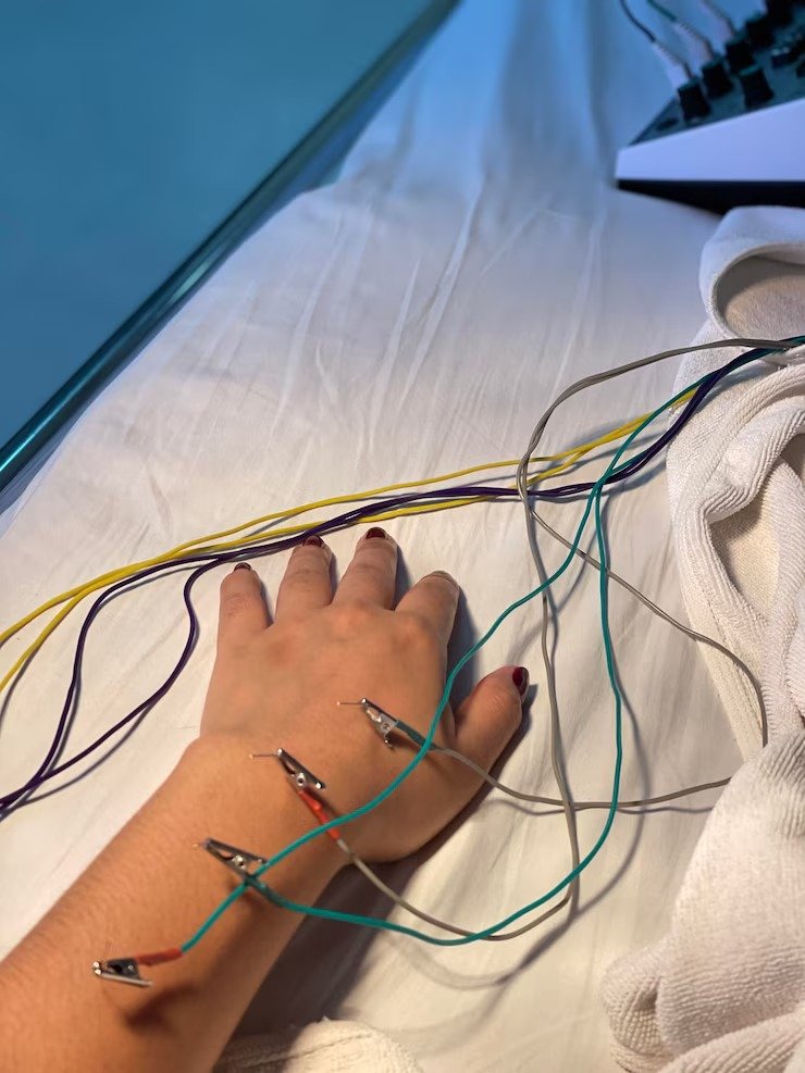 Nerve Conduction Study